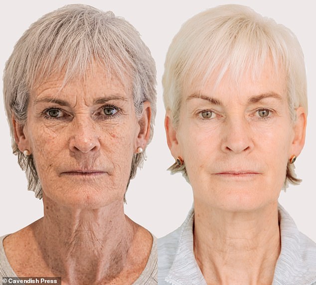 Judy Murray, 61, reveals the results of a £4,500 non-surgical facelift